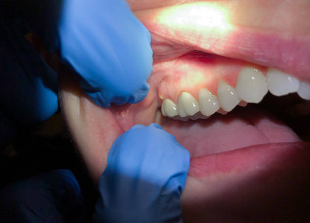 Best Emergency Treatment for Oral Infections in Jacksonwald, PA